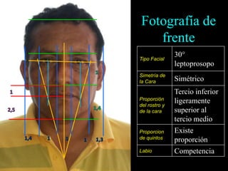 Fotografía de
frente
Tipo Facial
30°
leptoprosopo
Simetría de
la Cara Simétrico
Proporción
del rostro y
de la cara
Tercio inferior
ligeramente
superior al
tercio medio
Proporcion
de quintos
Existe
proporción
Labio Competencia
 