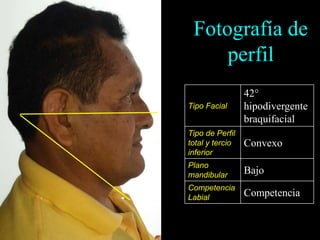 Fotografía de
perfil
Tipo Facial
42°
hipodivergente
braquifacial
Tipo de Perfil
total y tercio
inferior
Convexo
Plano
mandibular Bajo
Competencia
Labial Competencia
 