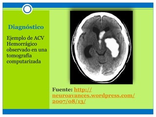 Fuente: http://
neuroavances.wordpress.com/
2007/08/13/
Ejemplo de ACV
Hemorrágico
observado en una
tomografía
computarizada
Diagnóstico
 