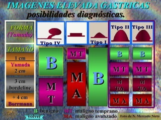 IMAGENES ELEVADA GASTRICASIMAGENES ELEVADA GASTRICAS
posibilidades diagnósticas.posibilidades diagnósticas.
1 cm1 cm
YamadaYamada
2 cm2 cm
+ 4 cm+ 4 cm
BorrmannBorrmann
3 cm3 cm
bordelinebordeline
FORMAFORMA
(Yamada)(Yamada)
TAMATAMAÑOÑO
BB
MM
TT
M TM T
MM
AA
BBBB
BBBB
M TM T
MM
T/AT/A
M AM A
BBBB
M TM T
MM
T/AT/A
M AM A
BB: benignobenigno MTMT: malignomaligno tempranotemprano
MAMA: malignomaligno avanzadoavanzadovolvervolver
Tipo IVTipo IV
Tipo IITipo II Tipo IIITipo III
Tipo ITipo I
Foto de N. Mercado NietoFoto de N. Mercado Nieto
NMNM
 