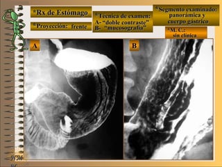 *Rx de Estómago*Rx de Estómago
**Proyección:Proyección:
**Técnica de examen:Técnica de examen:
A-A-
B-B- *M. C.:*M. C.:
sin clínicasin clínica
**Segmento examinado:Segmento examinado:
NMNM
E ME M
UNTUNT
BBAA
frentefrente
““doble contraste”doble contraste”
““mucosografía”mucosografía”
panorámica ypanorámica y
cuerpo gástricocuerpo gástrico
 