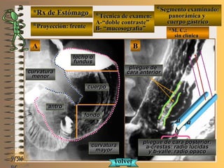 *Rx de Estómago*Rx de Estómago
**Proyección: frenteProyección: frente
**Técnica de examen:Técnica de examen:
A-“doble contraste”A-“doble contraste”
B- “mucosografía”B- “mucosografía” *M. C.:*M. C.:
sin clínicasin clínica
**Segmento examinado:Segmento examinado:
panorámica ypanorámica y
cuerpo gástricocuerpo gástrico
NMNM
E ME M
UNTUNT
BBAA
curvaturacurvatura
menormenor
curvaturacurvatura
mayormayor
techo otecho o
fundusfundus
cuerpocuerpo
fondofondo
antroantro
pliegue depliegue de
cara anteriorcara anterior
pliegue de cara posterior:pliegue de cara posterior:
a-crestas: radio lúcidasa-crestas: radio lúcidas
y b-valle: radio opacoy b-valle: radio opaco
volvervolver
aa aa
bb
 