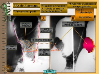 *Rx de Estómago*Rx de Estómago
**Proyección: perfilProyección: perfil
**Técnica de examen:Técnica de examen:
A-“doble contraste”A-“doble contraste”
B- “relleno total”B- “relleno total”
**Segmento examinado:Segmento examinado:
cuerpo gástricocuerpo gástrico
NMNM
N
E ME M
UNTUNT
BBAA
imagenimagen
elevadaelevada
imagen enimagen en
““falta de relleno”falta de relleno”
plieguespliegues
enen
puentepuente
caracara
anterioranterior
caracara
posteriorposterior
volvervolver
*M. C.:*M. C.:
epigastralgiaepigastralgia
inespecíficainespecífica
la misma imagenla misma imagen
 