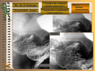 *Rx de Estómago*Rx de Estómago
**Proyección:Proyección:
**Técnica de examen:Técnica de examen:
**Segmento examinado:Segmento examinado:
NMNM
N
E ME M
UNTUNT
*M. C.:*M. C.:
melenamelena
hematemesishematemesis
detalledetalle
frentefrente
““doble contraste”doble contraste”
antro gástricoantro gástrico
 
