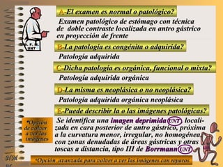A-A-El examen es normal o patológico?El examen es normal o patológico?
Examen patológico de estómago con técnicaExamen patológico de estómago con técnica
de doble contraste localizada en antro gástricode doble contraste localizada en antro gástrico
en proyección de frenteen proyección de frente
B-B-La patología es congénita o adquirida?La patología es congénita o adquirida?
Patología adquiridaPatología adquirida
D-D-La misma es neoplásica o no neoplásica?La misma es neoplásica o no neoplásica?
**OpciónOpción
de volverde volver
a ver lasa ver las
imágenesimágenes
Patología adquirida orgánica neoplásicaPatología adquirida orgánica neoplásica
E-E-Puede describir la o las imágenes patológicas?Puede describir la o las imágenes patológicas?
Se identifica unaSe identifica una imagen deprimidaimagen deprimida UNTUNT , locali-, locali-
zada en cara posterior de antro gástrico, próximazada en cara posterior de antro gástrico, próxima
a la curvatura menor, irregular, no homogénea,a la curvatura menor, irregular, no homogénea,
con zonas denudadas de áreas gástricas y otrascon zonas denudadas de áreas gástricas y otras
toscas a distancia, tipo III detoscas a distancia, tipo III de BorrmannBorrmann UNTUNT
NMNM
C-C-Dicha patología es orgánica, funcional o mixta?Dicha patología es orgánica, funcional o mixta?
Patología adquirida orgánicaPatología adquirida orgánica
**Opción avanzada para volver a ver las imágenes con reparosOpción avanzada para volver a ver las imágenes con reparos
D. F. M.D. F. M.
UNTUNT
E ME M
UNTUNT
 