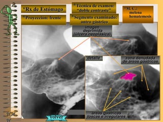 *Rx de Estómago*Rx de Estómago
**Proyección: frenteProyección: frente
**Técnica de examen:Técnica de examen:
““doble contraste”doble contraste”
**Segmento examinado:Segmento examinado:
antro gástricoantro gástrico
NMNM
N
E ME M
UNTUNT
*M. C.:*M. C.:
melenamelena
hematemesishematemesis
detalledetalle
imagenimagen
deprimidadeprimida
(úlcera neoplásica)(úlcera neoplásica)
zona denudadazona denudada
de áreas gástricasde áreas gástricas
áreas gástricasáreas gástricas
toscas e irregularestoscas e irregularesvolvervolver
 