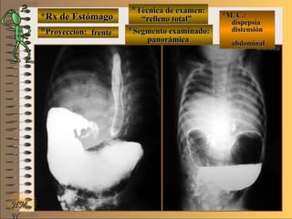 *Rx de Estómago*Rx de Estómago
**Proyección:Proyección:
**Técnica de examen:Técnica de examen:
**Segmento examinado:Segmento examinado:
NMNM
N
E ME M
UNTUNT
*M. C.:*M. C.:
dispepsiadispepsia
distensióndistensión
abdominalabdominal
frentefrente
““relleno total”relleno total”
panorámicapanorámica
 
