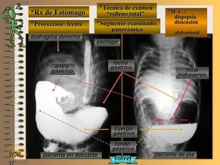 *Rx de Estómago*Rx de Estómago
**Proyección: frenteProyección: frente
**Técnica de examen:Técnica de examen:
““relleno total”relleno total”
**Segmento examinado:Segmento examinado:
panorámicapanorámica
NMNM
N
E ME M
UNTUNT
*M. C.:*M. C.:
dispepsiadispepsia
distensióndistensión
abdominalabdominal
paciente en decúbitopaciente en decúbito paciente de piepaciente de pie
diafragma derechodiafragma derecho
esófagoesófago
techotecho
gástricogástrico
cuerpocuerpo
gástricogástrico
fondofondo
gástricogástrico
antroantro
gástricogástrico nivelnivel
hidroaereohidroaereo
volvervolver
 