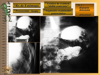 *Rx de Estómago*Rx de Estómago
**Proyección:Proyección:
**Técnica de examen:Técnica de examen:
**Segmento examinado:Segmento examinado:
NMNM
N
E ME M
UNTUNT
*M. C.:*M. C.:
dispepsiadispepsia
distensióndistensión
abdominalabdominal
detalledetalle
frentefrente
““doble contraste”doble contraste”
panorámicapanorámica
 