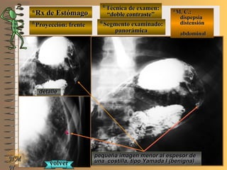 *Rx de Estómago*Rx de Estómago
**Proyección: frenteProyección: frente
**Técnica de examen:Técnica de examen:
““doble contraste”doble contraste”
**Segmento examinado:Segmento examinado:
panorámicapanorámica
NMNM
N
E ME M
UNTUNT
*M. C.:*M. C.:
dispepsiadispepsia
distensióndistensión
abdominalabdominal
detalledetalle
pequeña imagen menor al espesor depequeña imagen menor al espesor de
una costilla, tipo Yamada I (benigna)una costilla, tipo Yamada I (benigna)volvervolver
 