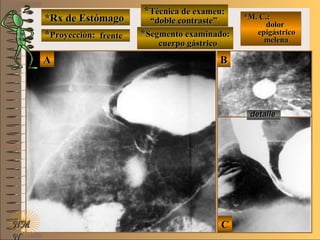 *Rx de Estómago*Rx de Estómago
**Proyección:Proyección:
**Técnica de examen:Técnica de examen:
**Segmento examinado:Segmento examinado:
NMNM
N
E ME M
UNTUNT
*M. C.:*M. C.:
dolordolor
epigástricoepigástrico
melenamelena
detalledetalle
BBAA
CC
frentefrente
““doble contraste”doble contraste”
cuerpo gástricocuerpo gástrico
 
