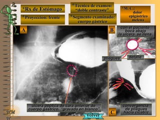 *Rx de Estómago*Rx de Estómago
**Proyección: frenteProyección: frente
**Técnica de examen:Técnica de examen:
““doble contraste”doble contraste”
**Segmento examinado:Segmento examinado:
cuerpo gástricocuerpo gástrico
NMNM
N
E ME M
UNTUNT
*M. C.:*M. C.:
dolordolor
epigástricoepigástrico
melenamelena
BBAA
CC
con el pacientecon el paciente
boca abajoboca abajo
la ulcera se llenala ulcera se llena
volvervolver
ulcera péptica de cara anterior deulcera péptica de cara anterior de
cuerpo gástrico, “gravada en blanco”cuerpo gástrico, “gravada en blanco”
convergenciaconvergencia
de plieguesde pliegues
hacia cicatrizhacia cicatriz
detalledetalleplieguespliegues
 
