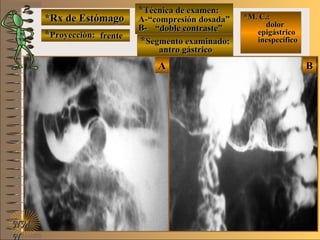 BBAA
*Rx de Estómago*Rx de Estómago
**Proyección:Proyección:
**Técnica de examen:Técnica de examen:
A-A-
B-B-
**Segmento examinado:Segmento examinado:
NMNM
N
E ME M
UNTUNT
*M. C.:*M. C.:
dolordolor
epigástricoepigástrico
inespecíficoinespecíficofrentefrente
““compresión dosada”compresión dosada”
““doble contraste”doble contraste”
antro gástricoantro gástrico
 