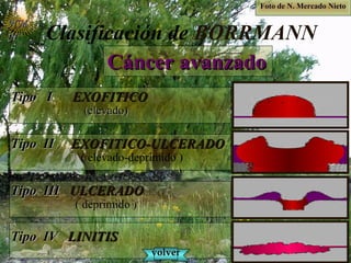 Clasificación de BORRMANN
Cáncer avanzadoCáncer avanzado
Tipo ITipo I EXOFITICOEXOFITICO
(elevado)(elevado)
Tipo IITipo II EXOFITICO-ULCERADOEXOFITICO-ULCERADO
( elevado-deprimido )
Tipo IIITipo III ULCERADOULCERADO
( deprimido )
Tipo IVTipo IV LINITISLINITIS
NMNM
NN
volvervolver
Foto de N. Mercado NietoFoto de N. Mercado Nieto
 