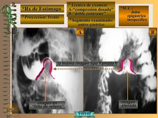 BBAA
*Rx de Estómago*Rx de Estómago
**Proyección: frenteProyección: frente
**Técnica de examen:Técnica de examen:
A-“compresión dosada”A-“compresión dosada”
B-“doble contraste”B-“doble contraste”
**Segmento examinado:Segmento examinado:
antro gástricoantro gástrico
NMNM
N
E ME M
UNTUNT
*M. C.:*M. C.:
dolordolor
epigástricoepigástrico
inespecíficoinespecífico
la misma imagenla misma imagen tipo Yamada IItipo Yamada II
imagenimagen
elevadaelevada
imagen enimagen en
““falta de relleno”falta de relleno”
volvervolver
 