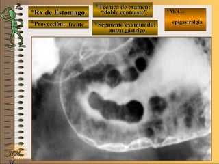 *Rx de Estómago*Rx de Estómago
**Proyección:Proyección:
**Técnica de examen:Técnica de examen:
**Segmento examinado:Segmento examinado:
NMNM
N
E ME M
UNTUNT
*M. C.:*M. C.:
epigastralgiaepigastralgia
frentefrente
““doble contraste”doble contraste”
antro gástricoantro gástrico
 