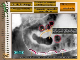 *Rx de Estómago*Rx de Estómago
**Proyección: frenteProyección: frente
**Técnica de examen:Técnica de examen:
““doble contraste”doble contraste”
**Segmento examinado:Segmento examinado:
antro gástricoantro gástrico
NMNM
N
E ME M
UNTUNT
*M. C.:*M. C.:
epigastralgiaepigastralgia
imágenes elevadas queimágenes elevadas que
siguen el eje de un plie-siguen el eje de un plie-
gue de cara posteriorgue de cara posterior
imágenes elevadas vistas de perfil sobre curvatura mayorimágenes elevadas vistas de perfil sobre curvatura mayor
volvervolver
 