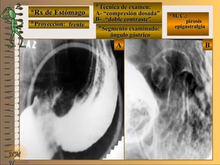 *Rx de Estómago*Rx de Estómago
**Proyección:Proyección:
**Técnica de examen:Técnica de examen:
A-A-
B-B-
**Segmento examinado:Segmento examinado:
NMNM
N
E ME M
UNTUNT
*M. C.:*M. C.:
pirosispirosis
epigastralgiaepigastralgia
BBAA
frentefrente
““compresión dosada”compresión dosada”
““doble contraste”doble contraste”
ángulo gástricoángulo gástrico
 