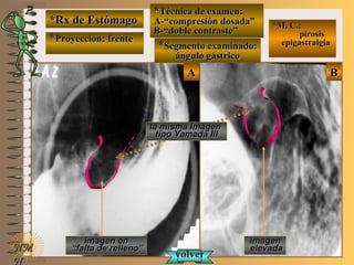 *Rx de Estómago*Rx de Estómago
**Proyección: frenteProyección: frente
**Técnica de examen:Técnica de examen:
A-“compresión dosada”A-“compresión dosada”
B-“doble contraste”B-“doble contraste”
**Segmento examinado:Segmento examinado:
ángulo gástricoángulo gástrico
NMNM
N
E ME M
UNTUNT
*M. C.:*M. C.:
pirosispirosis
epigastralgiaepigastralgia
BBAA
imagenimagen
elevadaelevada
imagen enimagen en
““falta de relleno”falta de relleno”
volvervolver
la misma imagenla misma imagen
tipo Yamada IIItipo Yamada III
 