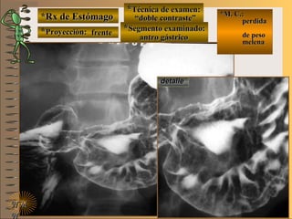 *Rx de Estómago*Rx de Estómago
**Proyección:Proyección:
**Técnica de examen:Técnica de examen:
**Segmento examinado:Segmento examinado:
NMNM
N
E ME M
UNTUNT
*M. C.:*M. C.:
perdidaperdida
de pesode peso
melenamelena
detalledetalle
frentefrente
““doble contraste”doble contraste”
antro gástricoantro gástrico
 