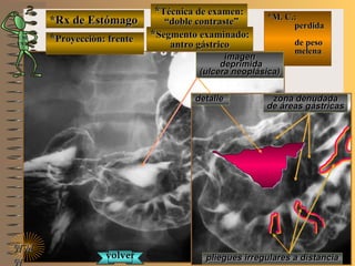 *Rx de Estómago*Rx de Estómago
**Proyección: frenteProyección: frente
**Técnica de examen:Técnica de examen:
““doble contraste”doble contraste”
**Segmento examinado:Segmento examinado:
antro gástricoantro gástrico
NMNM
N
E ME M
UNTUNT
*M. C.:*M. C.:
perdidaperdida
de pesode peso
melenamelena
imagenimagen
deprimidadeprimida
(ulcera neoplásica)(ulcera neoplásica)
zona denudadazona denudada
de áreas gástricasde áreas gástricas
pliegues irregulares a distanciapliegues irregulares a distanciavolvervolver
detalledetalle
 
