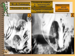 *Rx de Estómago*Rx de Estómago
**Proyección:Proyección:
**Técnica de examen:Técnica de examen:
A-A-
B-B-
**Segmento examinado:Segmento examinado:
NMNM
N
E ME M
UNTUNT
*M. C.:*M. C.:
pirosispirosis
epigastralgiaepigastralgia
BBAA
frentefrente
““mucosografía”mucosografía”
““relleno”relleno”
fondo gástricofondo gástrico
 