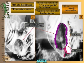 *Rx de Estómago*Rx de Estómago
**Proyección: frenteProyección: frente
**Técnica de examen:Técnica de examen:
A-“mucosografía”A-“mucosografía”
B- “relleno”B- “relleno”
**Segmento examinado:Segmento examinado:
fondo gástricofondo gástrico
NMNM
N
E ME M
UNTUNT
*M. C.:*M. C.:
pirosispirosis
epigastralgiaepigastralgia
BBAA
imagen enimagen en
““falta de relleno”falta de relleno”
cabezacabeza
pedículopedículo
volvervolver
 