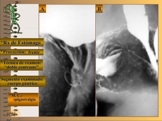E ME M
UNTUNT
*Rx de Estómago*Rx de Estómago
**Proyección:Proyección:
**Técnica de examen:Técnica de examen:
**Segmento examinado:Segmento examinado:
*M. C.:*M. C.:
epigastralgiaepigastralgia
NMNM
BBAA
frentefrente
““doble contraste”doble contraste”
cuerpo gástricocuerpo gástrico
 