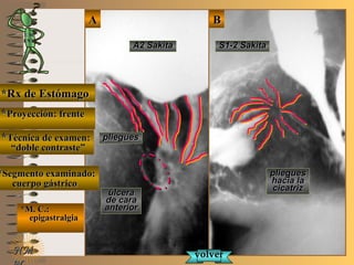 E ME M
UNTUNT
*Rx de Estómago*Rx de Estómago
**Proyección: frenteProyección: frente
**Técnica de examen:Técnica de examen:
““doble contraste”doble contraste”
**Segmento examinado:Segmento examinado:
cuerpo gástricocuerpo gástrico
*M. C.:*M. C.:
epigastralgiaepigastralgia
NMNM
BBAA
A2 SakitaA2 Sakita S1-2 SakitaS1-2 Sakita
úlceraúlcera
de carade cara
anterioranterior
plieguespliegues
plieguespliegues
hacia lahacia la
cicatrizcicatriz
volvervolver
 