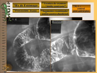 *Rx de Estómago*Rx de Estómago
**Proyección:Proyección:
**Técnica de examen:Técnica de examen:
**Segmento examinado:Segmento examinado:
NMNM
N
E ME M
UNTUNT
*M. C.:*M. C.:
controlcontrol
post quirúrgicopost quirúrgico
detalledetalle
frentefrente
““doble contraste”doble contraste”
unión gastro-duodenalunión gastro-duodenal
 