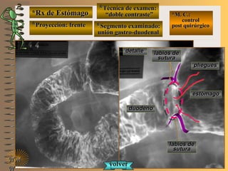 *Rx de Estómago*Rx de Estómago
**Proyección: frenteProyección: frente
**Técnica de examen:Técnica de examen:
““doble contraste”doble contraste”
**Segmento examinado:Segmento examinado:
unión gastro-duodenalunión gastro-duodenal
NMNM
N
E ME M
UNTUNT
*M. C.:*M. C.:
controlcontrol
post quirúrgicopost quirúrgico
detalledetalle labios delabios de
suturasutura
labios delabios de
suturasutura
estómagoestómago
duodenoduodeno
volvervolver
plieguespliegues
 
