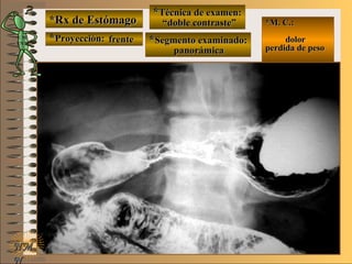 *Rx de Estómago*Rx de Estómago
**Proyección:Proyección:
**Técnica de examen:Técnica de examen:
**Segmento examinado:Segmento examinado:
NMNM
N
E ME M
UNTUNT
*M. C.:*M. C.:
dolordolor
perdida de pesoperdida de peso
frentefrente
““doble contraste”doble contraste”
panorámicapanorámica
 