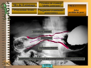 *Rx de Estómago*Rx de Estómago
**Proyección: frenteProyección: frente
**Técnica de examen:Técnica de examen:
““doble contraste”doble contraste”
**Segmento examinado:Segmento examinado:
panorámicapanorámica
NMNM
N
E ME M
UNTUNT
*M. C.:*M. C.:
dolordolor
perdida de pesoperdida de peso
estenosis mesogástrica que compromete ambas curvaturasestenosis mesogástrica que compromete ambas curvaturas
curvatura menorcurvatura menor
curvatura mayorcurvatura mayor
volvervolver
estenosisestenosis
 