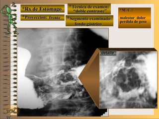 *Rx de Estómago*Rx de Estómago
**Proyección:Proyección:
**Técnica de examen:Técnica de examen:
**Segmento examinado:Segmento examinado:
NMNM
N
E ME M
UNTUNT
*M. C.:*M. C.:
malestar dolormalestar dolor
perdida de pesoperdida de peso
detalledetalle
frentefrente
““doble contraste”doble contraste”
fondo gástricofondo gástrico
 