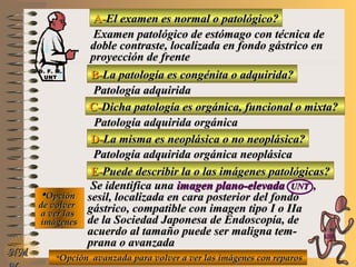A-A-El examen es normal o patológico?El examen es normal o patológico?
Examen patológico de estómago con técnica deExamen patológico de estómago con técnica de
doble contraste, localizada en fondo gástrico endoble contraste, localizada en fondo gástrico en
proyección de frenteproyección de frente
B-B-La patología es congénita o adquirida?La patología es congénita o adquirida?
Patología adquiridaPatología adquirida
D-D-La misma es neoplásica o no neoplásica?La misma es neoplásica o no neoplásica?
**OpciónOpción
de volverde volver
a ver lasa ver las
imágenesimágenes
Patología adquirida orgánica neoplásicaPatología adquirida orgánica neoplásica
E-E-Puede describir la o las imágenes patológicas?Puede describir la o las imágenes patológicas?
Se identifica unaSe identifica una imagen plano-elevadaimagen plano-elevada UNTUNT ,,
sesil, localizada en cara posterior del fondosesil, localizada en cara posterior del fondo
gástrico, compatible con imagen tipo I o IIagástrico, compatible con imagen tipo I o IIa
de la Sociedad Japonesa de Endoscopía, dede la Sociedad Japonesa de Endoscopía, de
acuerdo al tamaño puede ser maligna tem-acuerdo al tamaño puede ser maligna tem-
prana o avanzadaprana o avanzada
NMNM
C-C-Dicha patología es orgánica, funcional o mixta?Dicha patología es orgánica, funcional o mixta?
Patología adquirida orgánicaPatología adquirida orgánica
**Opción avanzada para volver a ver las imágenes con reparosOpción avanzada para volver a ver las imágenes con reparos
D. F. M.D. F. M.
UNTUNT
E ME M
UNTUNT
 