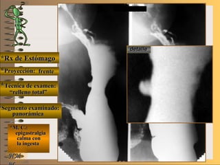 E ME M
UNTUNT
*Rx de Estómago*Rx de Estómago
**Proyección:Proyección:
**Técnica de examen:Técnica de examen:
**Segmento examinado:Segmento examinado:
*M. C.:*M. C.:
epigastralgiaepigastralgia
calma concalma con
la ingestala ingesta
NMNM
detalledetalle
frentefrente
““relleno total”relleno total”
panorámicapanorámica
 