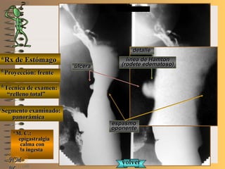 E ME M
UNTUNT
*Rx de Estómago*Rx de Estómago
**Proyección: frenteProyección: frente
**Técnica de examen:Técnica de examen:
““relleno total”relleno total”
**Segmento examinado:Segmento examinado:
panorámicapanorámica
*M. C.:*M. C.:
epigastralgiaepigastralgia
calma concalma con
la ingestala ingesta
NMNM
detalledetalle
úlceraúlcera
línea de Hamtonlínea de Hamton
(rodete edematoso)(rodete edematoso)
espasmoespasmo
oponenteoponente
volvervolver
 