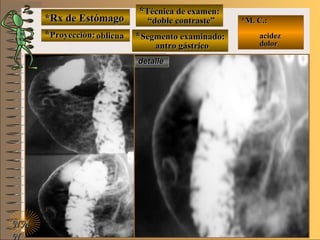 detalledetalle
*Rx de Estómago*Rx de Estómago
**Proyección:Proyección:
**Técnica de examen:Técnica de examen:
**Segmento examinado:Segmento examinado:
NMNM
N
E ME M
UNTUNT
*M. C.:*M. C.:
acidezacidez
dolordolor
oblicuaoblicua
““doble contraste”doble contraste”
antro gástricoantro gástrico
 