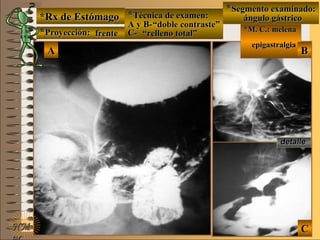 *Rx de Estómago*Rx de Estómago
**Proyección:Proyección:
**Técnica de examen:Técnica de examen:
A y B-A y B-
C-C-
**Segmento examinado:Segmento examinado:
*M. C.: melena*M. C.: melena
epigastralgiaepigastralgia
NMNM
E ME M
UNTUNT
BBAA
CC
detalledetalle
frentefrente
““doble contraste”doble contraste”
““relleno total”relleno total”
ángulo gástricoángulo gástrico
 