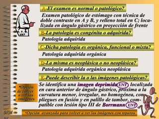 A-A-El examen es normal o patológico?El examen es normal o patológico?
Examen patológico de estómago con técnica deExamen patológico de estómago con técnica de
doble contraste en A y B, y relleno total en C; loca-doble contraste en A y B, y relleno total en C; loca-
lizada en ángulo gástrico en proyección de frentelizada en ángulo gástrico en proyección de frente
B-B-La patología es congénita o adquirida?La patología es congénita o adquirida?
Patología adquiridaPatología adquirida
D-D-La misma es neoplásica o no neoplásica?La misma es neoplásica o no neoplásica?
**OpciónOpción
de volverde volver
a ver lasa ver las
imágenesimágenes
Patología adquirida orgánica neoplásicaPatología adquirida orgánica neoplásica
E-E-Puede describir la o las imágenes patológicas?Puede describir la o las imágenes patológicas?
Se identifica unaSe identifica una imagen deprimidaimagen deprimida UNTUNT , localizada, localizada
en cara anterior de ángulo gástrico, próxima a laen cara anterior de ángulo gástrico, próxima a la
curvatura menor, irregular, no homogénea, concurvatura menor, irregular, no homogénea, con
pliegues en fusión y en palillo de tambor, com-pliegues en fusión y en palillo de tambor, com-
patible con lesión tipo III depatible con lesión tipo III de BorrmannBorrmann UNTUNT
NMNM
C-C-Dicha patología es orgánica, funcional o mixta?Dicha patología es orgánica, funcional o mixta?
Patología adquirida orgánicaPatología adquirida orgánica
**Opción avanzada para volver a ver las imágenes con reparosOpción avanzada para volver a ver las imágenes con reparos
D. F. M.D. F. M.
UNTUNT
E ME M
UNTUNT
 