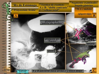 *Rx de Estómago*Rx de Estómago
**Proyección: frenteProyección: frente
**Técnica de examen:Técnica de examen:
A y B- “doble contraste”A y B- “doble contraste”
C-“relleno total”C-“relleno total”
**Segmento examinado:Segmento examinado:
ángulo gástricoángulo gástrico
*M. C.: melena*M. C.: melena
epigastralgiaepigastralgia
NMNM
E ME M
UNTUNT
BBAA
CC
detalledetalle
A y B-paciente boca arriba y C-boca abajoA y B-paciente boca arriba y C-boca abajo
pliegues enpliegues en
““palillo de tambor”palillo de tambor”
pliegues enpliegues en
““fusión”fusión”
ulceraulcera
volvervolver
 