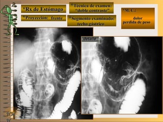 detalledetalle
*Rx de Estómago*Rx de Estómago
**Proyección:Proyección:
**Técnica de examen:Técnica de examen:
**Segmento examinado:Segmento examinado:
NMNM
N
E ME M
UNTUNT
*M. C.:*M. C.:
dolordolor
perdida de pesoperdida de peso
frentefrente
““doble contraste”doble contraste”
techo gástricotecho gástrico
 