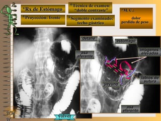 detalledetalle
*Rx de Estómago*Rx de Estómago
**Proyección: frenteProyección: frente
**Técnica de examen:Técnica de examen:
““doble contraste”doble contraste”
**Segmento examinado:Segmento examinado:
techo gástricotecho gástrico
NMNM
N
E ME M
UNTUNT
*M. C.:*M. C.:
dolordolor
perdida de pesoperdida de peso
imágenesimágenes
elevadaselevadas
estómagoestómago
yeyunoyeyuno
asaasa
aferenteaferente
asaasa
eferenteeferente
volvervolver
labios delabios de
suturasutura
 