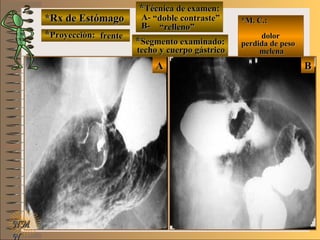*Rx de Estómago*Rx de Estómago
**Proyección:Proyección:
**Técnica de examen:Técnica de examen:
A-A-
B-B-
**Segmento examinado:Segmento examinado:
NMNM
N
E ME M
UNTUNT
*M. C.:*M. C.:
dolordolor
perdida de pesoperdida de peso
melenamelena
BBAA
frentefrente
““doble contraste”doble contraste”
““relleno”relleno”
techo y cuerpo gástricotecho y cuerpo gástrico
 