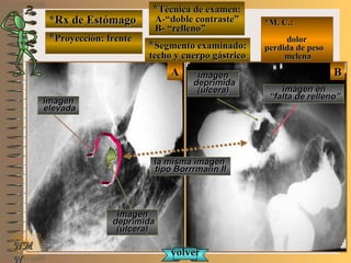 *Rx de Estómago*Rx de Estómago
**Proyección: frenteProyección: frente
**Técnica de examen:Técnica de examen:
A-“doble contraste”A-“doble contraste”
B- “relleno”B- “relleno”
**Segmento examinado:Segmento examinado:
techo y cuerpo gástricotecho y cuerpo gástrico
NMNM
N
E ME M
UNTUNT
*M. C.:*M. C.:
dolordolor
perdida de pesoperdida de peso
melenamelena
BBAA
imagenimagen
elevadaelevada
imagen enimagen en
““falta de relleno”falta de relleno”
imagenimagen
deprimidadeprimida
(ulcera)(ulcera)
imagenimagen
deprimidadeprimida
(ulcera)(ulcera)
la misma imagenla misma imagen
tipo Borrrmann IItipo Borrrmann II
volvervolver
 