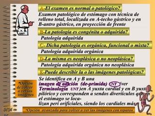 A-A-El examen es normal o patológico?El examen es normal o patológico?
Examen patológico de estómago con técnica deExamen patológico de estómago con técnica de
relleno total, localizada en A-techo gástrico y enrelleno total, localizada en A-techo gástrico y en
B-antro gástrico, en proyección de frenteB-antro gástrico, en proyección de frente
B-B-La patología es congénita o adquirida?La patología es congénita o adquirida?
Patología adquiridaPatología adquirida
C-C- Dicha patología es orgánica, funcional o mixta?Dicha patología es orgánica, funcional o mixta?
**OpciónOpción
de volverde volver
a ver lasa ver las
imágenesimágenes
Patología adquirida orgánicaPatología adquirida orgánica
D-D-La misma es neoplásica o no neoplásica?La misma es neoplásica o no neoplásica?
Patología adquirida orgánica no neoplásicaPatología adquirida orgánica no neoplásica
E-E-Puede describir la o las imágenes patológicas?Puede describir la o las imágenes patológicas?
Se identifica en A y B unaSe identifica en A y B una
imagen de adición (de-primida)imagen de adición (de-primida) UNTUNT (ver(ver
TerminologíaTerminología UNTUNT )en A yuxta cardial y en B yuxta)en A yuxta cardial y en B yuxta
pilórico y corresponden a sendos divertículos que enpilórico y corresponden a sendos divertículos que en
el estómago se loca-el estómago se loca-
lizan peri orificiales, siendo los cardiales máslizan peri orificiales, siendo los cardiales más
frecuentes (+98%) que los pilóricosfrecuentes (+98%) que los pilóricos**Opción avanzada para volver a ver las imágenes con reparosOpción avanzada para volver a ver las imágenes con reparosNMNM
D. F. M.D. F. M.
UNTUNT
E ME M
UNTUNT
 