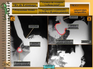 *Rx de Estómago*Rx de Estómago
**Proyección: frenteProyección: frente
**Técnica de examen:Técnica de examen:
““relleno total”relleno total”
**Segmento examinado:Segmento examinado:
A-techo y B-antro gástricoA-techo y B-antro gástrico
NMNM
N
E ME M
UNTUNT
*M. C.:*M. C.:
epigastralgiaepigastralgia
inespecíficainespecífica
BBAA
detalledetalle
divertículodivertículo
yuxta cardialyuxta cardial
divertículodivertículo
yuxta pilóricoyuxta pilórico
cardiascardias
píloropíloro
techotecho
gástricogástrico
antroantro
gástricogástrico
volvervolver
 