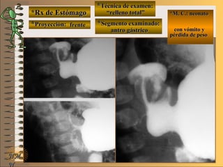 *Rx de Estómago*Rx de Estómago
**Proyección:Proyección:
**Técnica de examen:Técnica de examen:
**Segmento examinado:Segmento examinado:
NMNM
N
E ME M
UNTUNT
*M. C.: neonato*M. C.: neonato
con vómito ycon vómito y
pérdida de pesopérdida de peso
frentefrente
““relleno total”relleno total”
antro gástricoantro gástrico
 