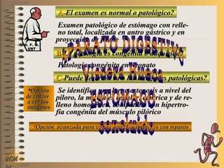 A-A-El examen es normal o patológico?El examen es normal o patológico?
Examen patológico de estómago con relle-Examen patológico de estómago con relle-
no total, localizada en antro gástrico y enno total, localizada en antro gástrico y en
proyección de frenteproyección de frente
B-B-La patología es congénita o adquirida?La patología es congénita o adquirida?
Patología congénita en neonatoPatología congénita en neonato
C-C-Puede describir la o las imágenes patológicas?Puede describir la o las imágenes patológicas?
**OpciónOpción
de volverde volver
a ver lasa ver las
imágenesimágenes
Se identifica una larga estenosis a nivel delSe identifica una larga estenosis a nivel del
píloro, la misma es regular, céntrica y de re-píloro, la misma es regular, céntrica y de re-
lleno homogéneo, compatible con hipertro-lleno homogéneo, compatible con hipertro-
fia congénita del músculo pilóricofia congénita del músculo pilórico
**Opción avanzada para volver a ver las imágenes con reparosOpción avanzada para volver a ver las imágenes con reparos
NMNM
D. F. M.D. F. M.
UNTUNT
E ME M
UNTUNT
 