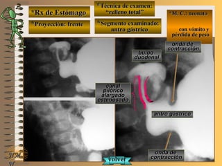 *Rx de Estómago*Rx de Estómago
**Proyección: frenteProyección: frente
**Técnica de examen:Técnica de examen:
““relleno total”relleno total”
**Segmento examinado:Segmento examinado:
antro gástricoantro gástrico
NMNM
N
E ME M
UNTUNT
*M. C.: neonato*M. C.: neonato
con vómito ycon vómito y
pérdida de pesopérdida de peso
canalcanal
pilóricopilórico
alargadoalargado
estenosadoestenosado
antro gástricoantro gástrico
bulbobulbo
duodenalduodenal
onda deonda de
contraccióncontracción
onda deonda de
contraccióncontracciónvolvervolver
 